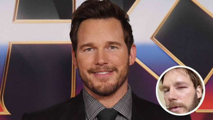 Chris Pratt Stung In Eye By Bee After Watching Viral Bee Lady: "I Think I Can Control Bees, Too"