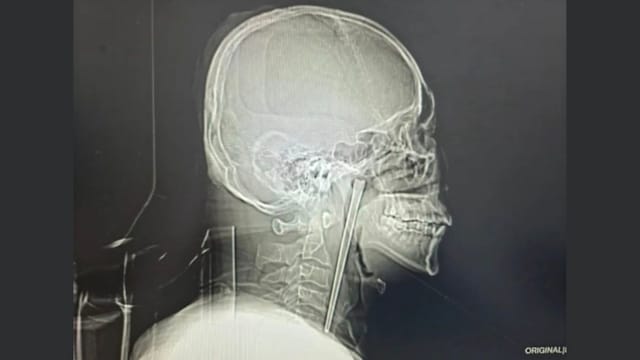 怕开刀拖延治疗 中国男子误吞金属筷子八年终取出