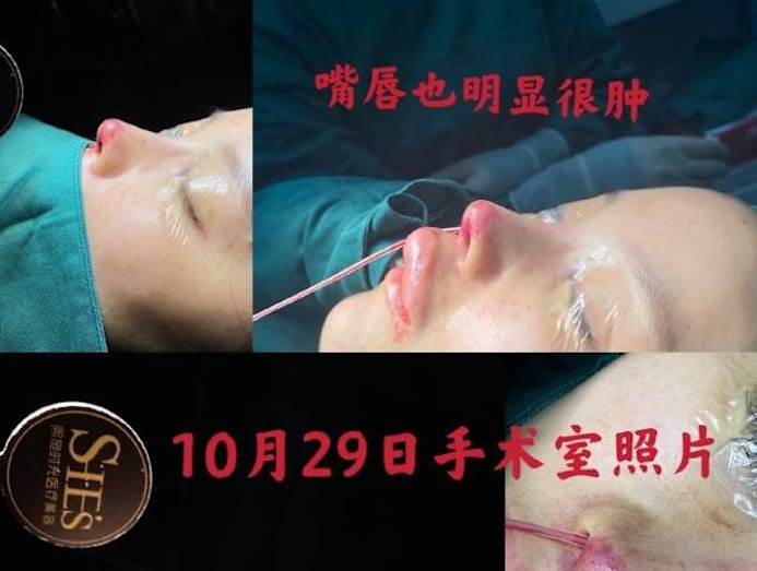 Chinese Actress Gao Liu s Nose Job Went So Horribly Wrong The Tip Of chinese-actress-gao-liu-s-nose-job-went-so-horribly-wrong-the-tip-of