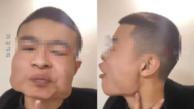 中国小伙嚼槟榔八年变方块脸 网民：还以为是特效