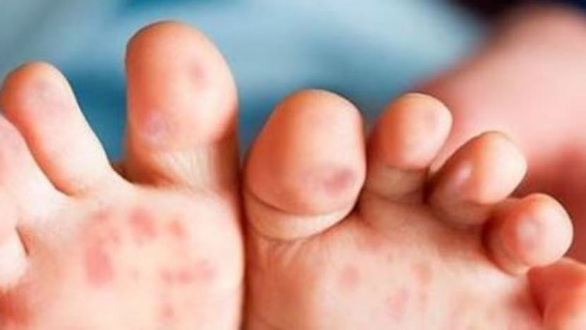 Masih ramai ibu bapa tidak peka HFMD Masih ramai ibu bapa tidak peka HFMD