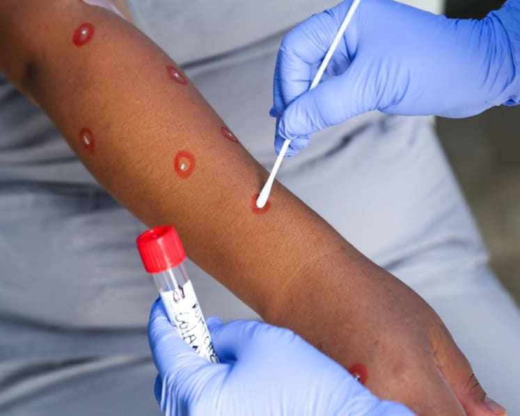 Singapore reports 11th case of monkeypox infection 