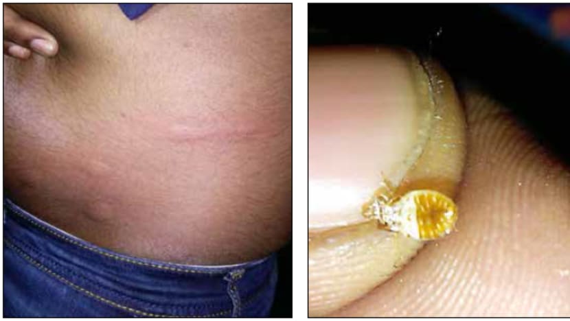 Passenger complains of bedbug bites on Singapore-bound coach ride from KL