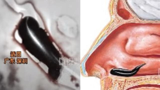 中国男孩鼻子发痒出血 鼻孔内竟藏三厘米水蛭