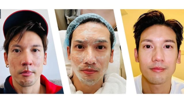 关智斌家中瓦斯外泄误燃　“二级烧伤”毁容照曝光