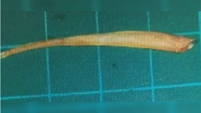 吃鱼出意外 鱼刺卡肛门 台女终身洗肾