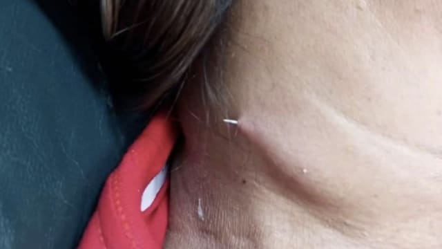 泰女误吞鱼刺医生没验出 两周后从颈部穿透出来