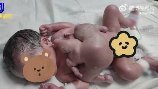 深圳男婴长“寄生胎” 出生时有四手四脚
