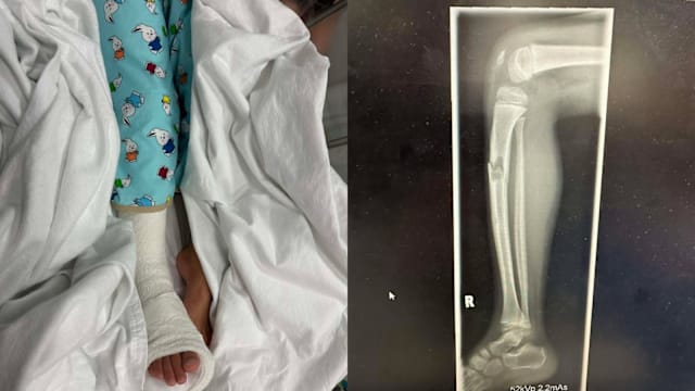 儿子在新山游乐场摔伤骨折 狮城父控工作人员拒让婴儿车入内