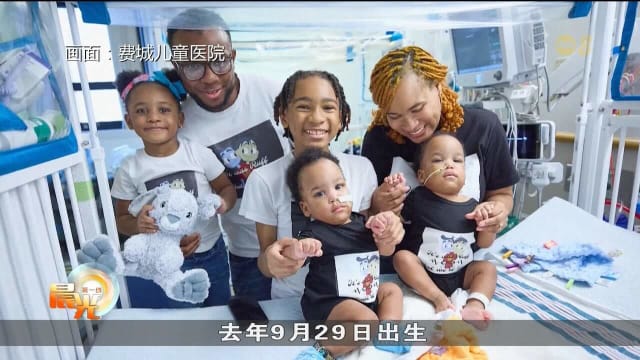 美国腹部相连双胞胎兄弟 手术八小时后成功分离