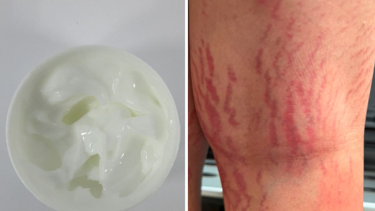 Kem thảo dược B-Lian-S bị pha trộn steroid mạnh và chất chống nấm đã khiến một bé trai 12 tuổi bị rạn da. (Photos: Health Sciences Authority, Patient) (Ảnh: CNA)