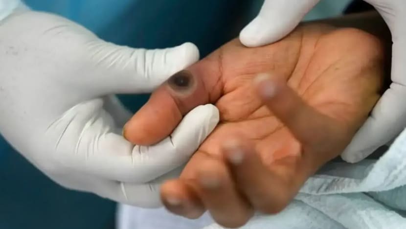 Maghribi sahkan kes pertama mpox Maghribi sahkan kes pertama mpox