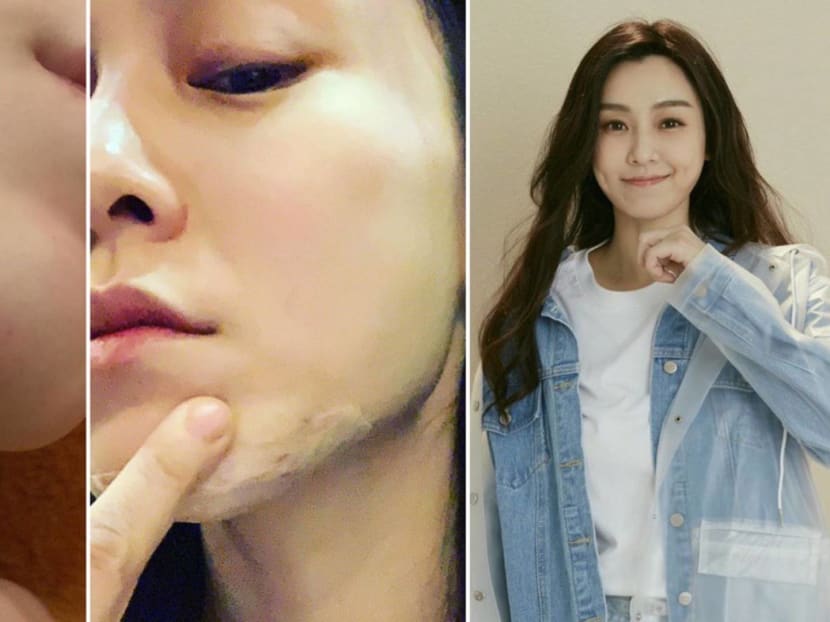 She needed 15 stitches.