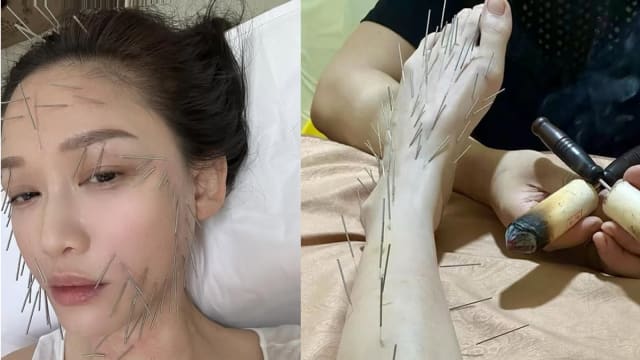 陈乔恩全身扎针调理身子，搞笑玩梗“容嬷嬷我是不会招的”