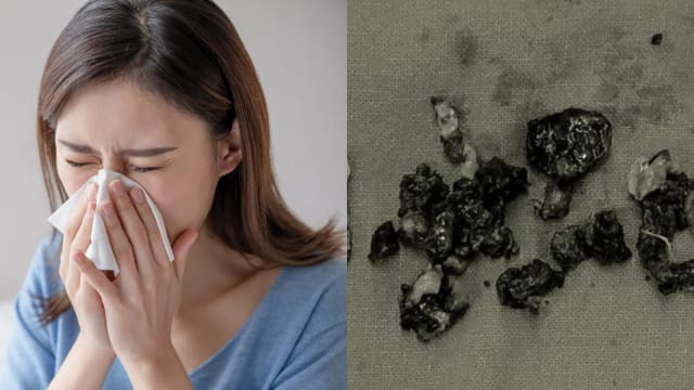 台妇鼻腔飘“脚臭味” 医生挖出大量霉菌鼻屎