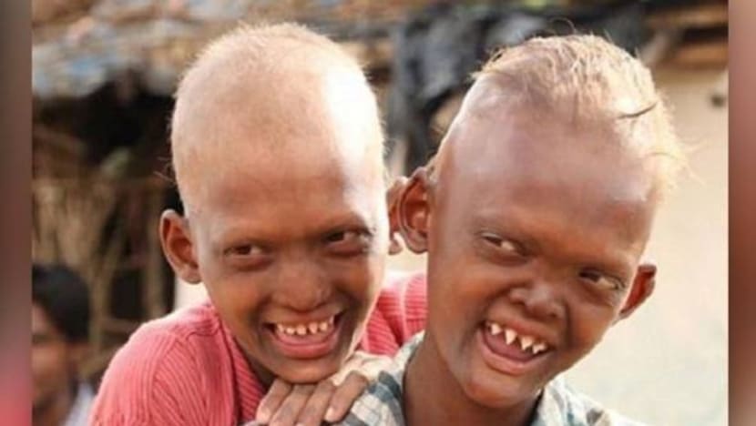 Dua beradik digelar 'hantu' kerana gigi bertaring
