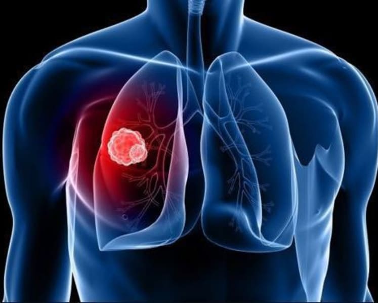 Lung cancer doesn’t only affect men or heavy smokers