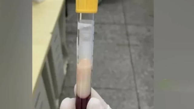 吃烧烤后腹痛求医 中国男竟抽出牛奶色血液 