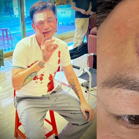 阿Ben拍戏受伤“白衣染血”!额头缝数针仍乐观,眼睛眉毛都没事,坚强乐观引人瞩目