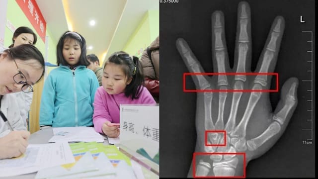 东莞九岁女来月经确诊性早熟 医生：问题藏生活习惯中