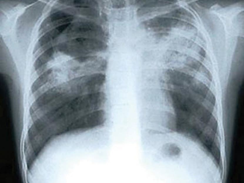 Tuberculosis x-ray. TODAY file photo