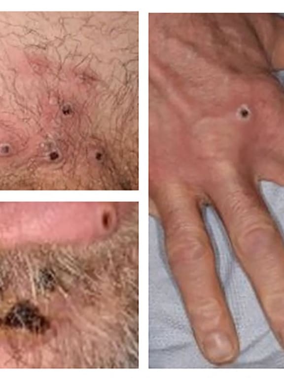 <span style="font-size:16.0pt"><span style="font-family:"Arial",sans-serif">A handout picture made available by the UK Health Security Agency on June 22, 2022 shows images of monkeypox rash lesions on an infected person. </span></span>