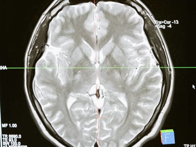 Commentary: Even mild cases of COVID-19 might be bad for our brains