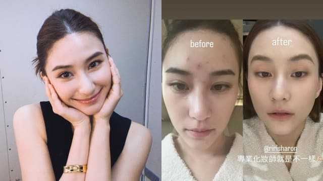 额头爆痘患容貌焦虑　何超莲自认靠2招“照骗”
