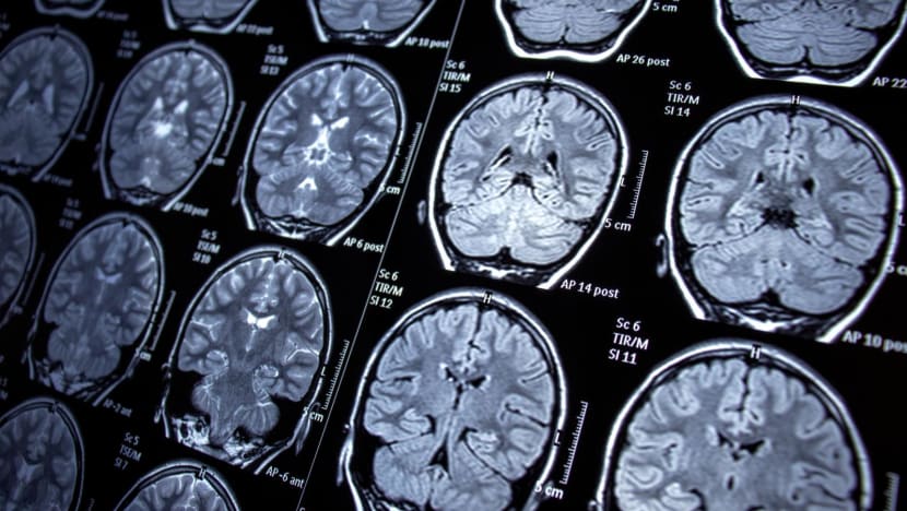 Commentary: The middle-aged brain changes a lot - and is key to understanding dementia Commentary: The middle-aged brain changes a lot - and is key to understanding dementia