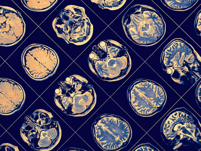 Singapore researchers identify two genes associated with risk of schizophrenia