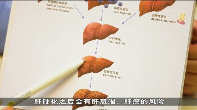 受访医生：本地约30%到40%人口患有脂肪肝 与喜欢高热量饮食有关