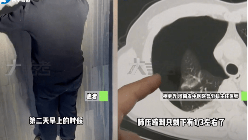 Man’s Lung Collapses After Doing 20 Push-Ups And Skipping Rope Man’s Lung Collapses After Doing 20 Push-Ups And Skipping Rope