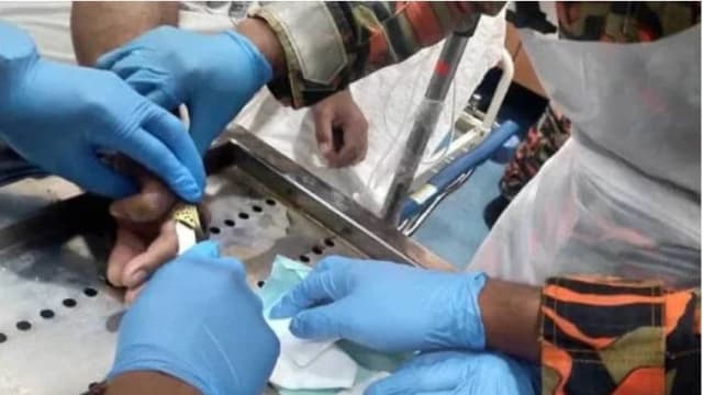 马男戒指卡无名指 手指腐烂近断才求助