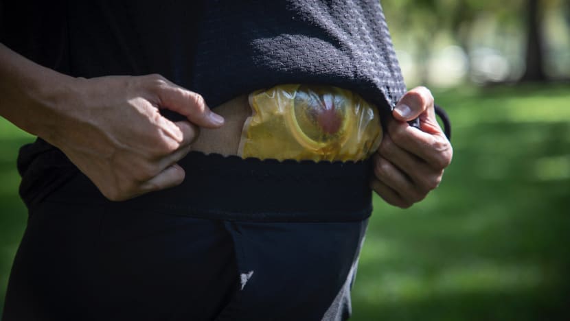 Living with a stoma pouch: What a 39-year-old colorectal cancer survivor and doctors want you to know