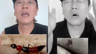 Sleeping Naked Left Jaspers Lai With Painful Blisters After Charlie Ant Attack