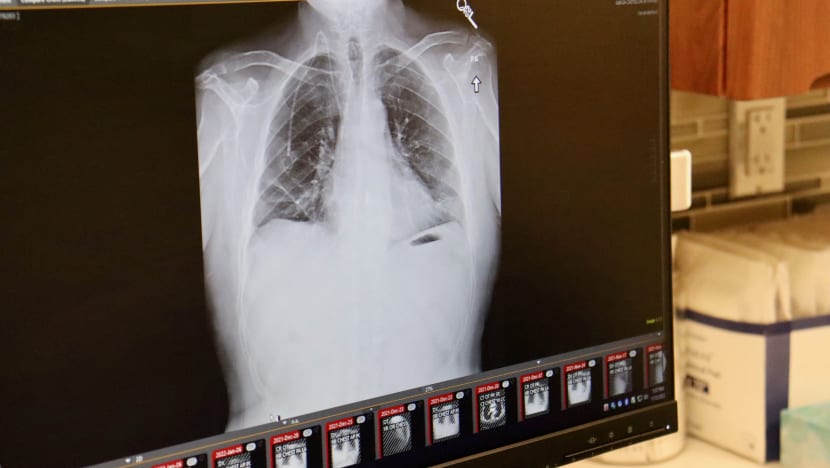 Doktor ini kongsi kisah lelaki yang meninggal dunia akibat rokok; paru-paru bernanah dan batuk berdarah