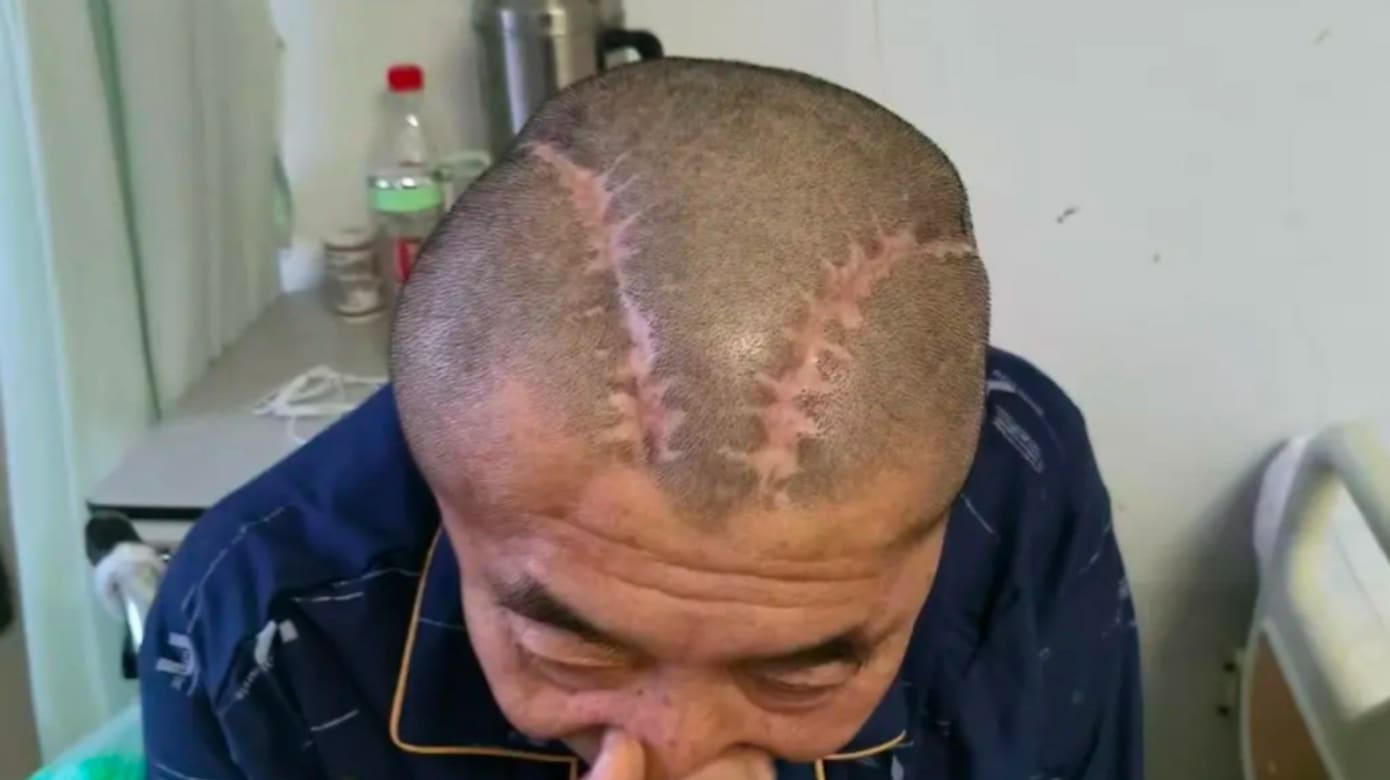 中国男子摔倒右脑出血  医生动手术却误开左脑家属投诉