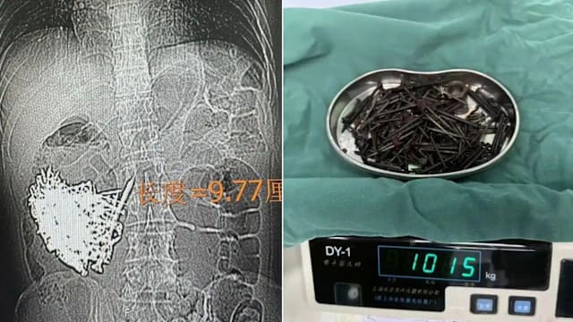 中国男子疑患精神病吞金属异物 医生取出180颗铁钉