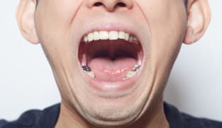 You could start losing teeth in your 30s – how to keep the rest of them before it’s too late