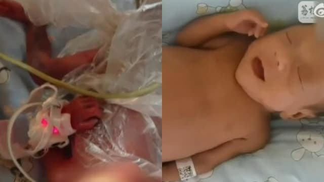 中国孕妇21周羊水渗漏 胎儿小脚伸出来