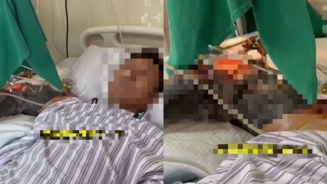 将手伸出窗外遇车祸 中国男子右臂断成三截