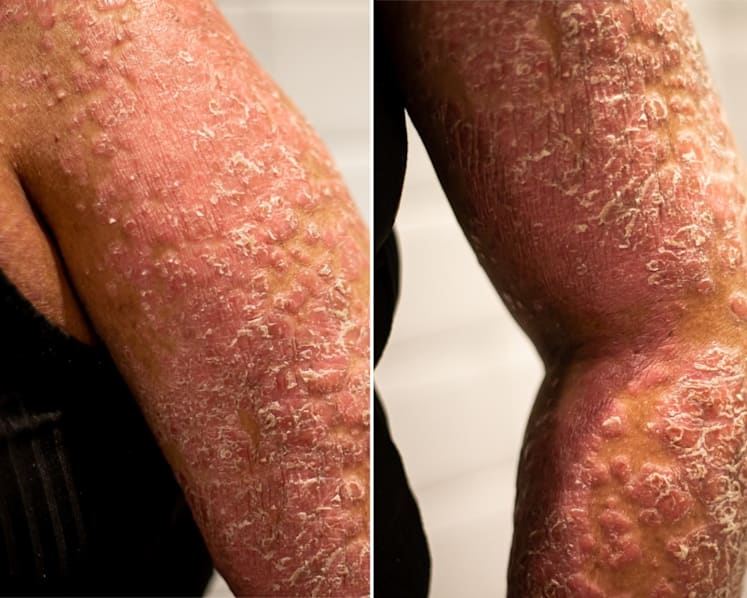 ‘Smells like rotten fish, feels like a curse’: Pain, odour and isolation for people with rare skin disease 