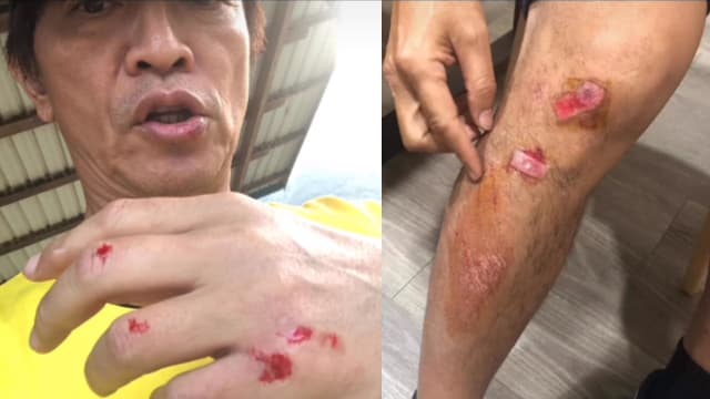 手脚磨破皮见血　吴宗宪突晒多年前伤照