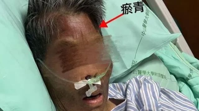 台中八旬阿嬷遭外籍看护长期施暴 社会局介入调查