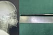 Man Lives With 12cm Metal Chopstick In Throat For 8 Years