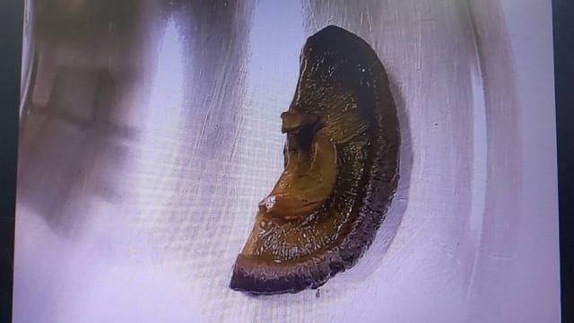 台男吃饭不嚼碎食物 半个香菇卡在肠胃得开刀 