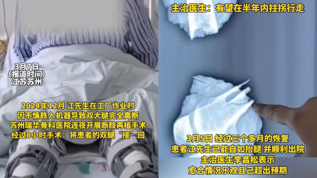 中国男子双腿被机器绞断 医疗团队八小时成功接回