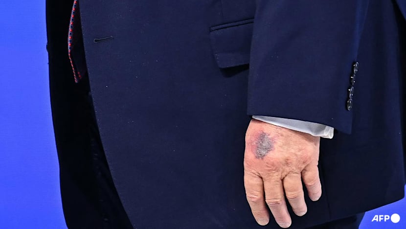 Trump bruised hand on table, he says of new photos