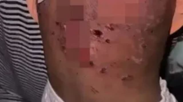 被亲生母亲和女子虐待 马国七岁男童背部皮开肉绽