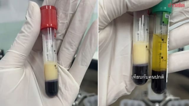 泰国男子天天喝酒 抽血惊见厚厚一层脂肪如炼乳